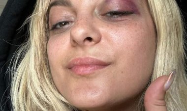 تعليق صادم من شاب تسبب في إصابة بيبي ريسكا بـ3 غرز في وجهها