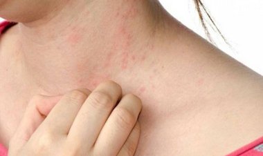حساسية القمح.. مرض يصيب الجهاز المناعي ويسبب مضاعفات خطيرة