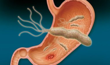 استشاري يحذر من مخاطر جرثومة المعدة.. تسبب السرطان