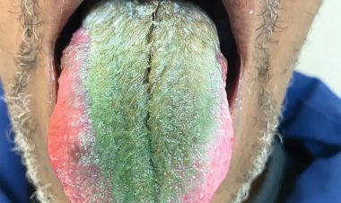 بسبب التدخين.. نمو شعر أخضر على لسان رجل أمريكي