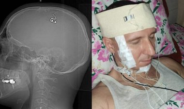 شخص يجري جراحة على نفسه من أجل التحكم بالأحلام.. أعرف التفاصيل