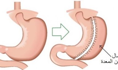 استشاري تغذية علاجية: تناول السعرات الحرارية بكثرة يؤدي إلى رجوع الوزن بعد الخضوع لعملية التكميم
