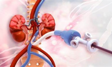 تعالج تصلب الشرايين.. معلومات مهمة عن الدعامات القلبية