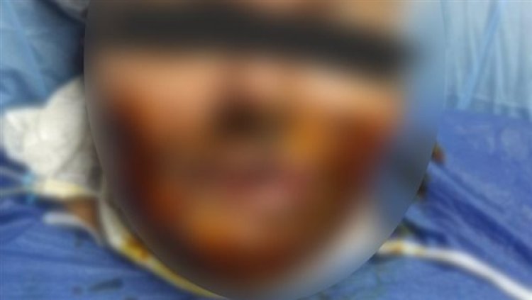 بسبب خلافات على الميراث.. نقاش يشوه جسد شقيقته وزوجها بماء النار في منشأة ناصر
