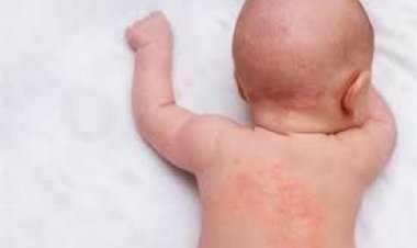 بعد انتشار فيروس حمى النيل بين الأطفال.. اعرف طرق علاجه بالمنزل