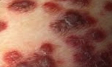 أمريكا تُحذّر من بكتيريا خطيرة آكلة للحوم.. إليك أبرز أعراضها