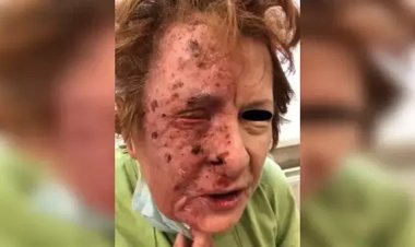 شيء نادر الحدوث.. تشوه وجه امرأة بعد إصابة عصبية وقيامها بتمزيق جلدها