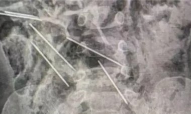 طفل صغير تحت سن السنتين يبتلع «8 إبر حقن»