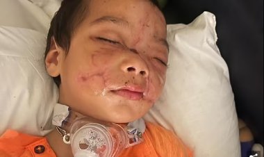 طفل يخضع لـ 12 عملية جراجية بعد هجوم كلب الجيران عليه