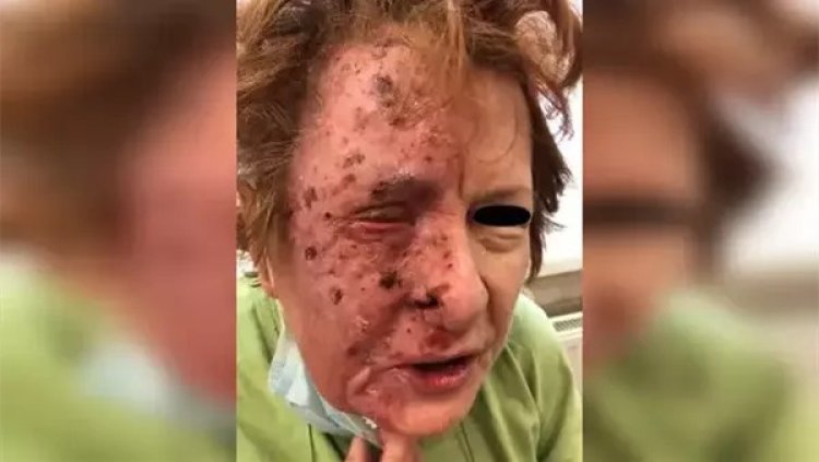 شيء نادر الحدوث.. تشوه وجه امرأة بعد إصابة عصبية وقيامها بتمزيق جلدها