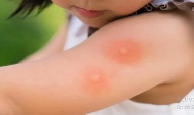 أخصائي الجلدية والتجميل تقدم روشتة للتعامل مع الأطفال بفصل الشتاء