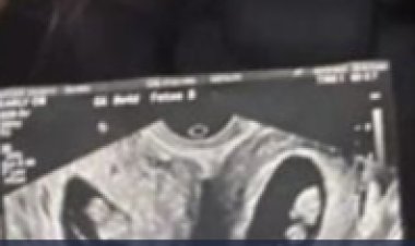 تؤمان في أرحام مختلفة .. كيف ذلك؟