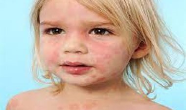 ما هي  أسباب حساسية الجلد ؟