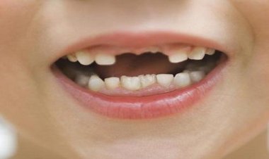 تفسير سقوط الأسنان في الحلم