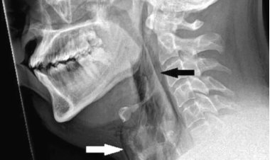 رجل يتعرض لخطر الموت بسبب «كتم عطسة»
