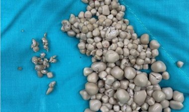 امرأة تزيل أكثر من 300 حصوة من كليتها اليمنى