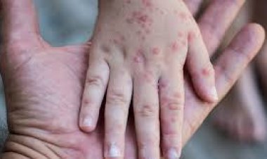 الصحة لـ العاصمة: لا يوجد انتشار للجديري المائي في المدارس… لا تقلقوا