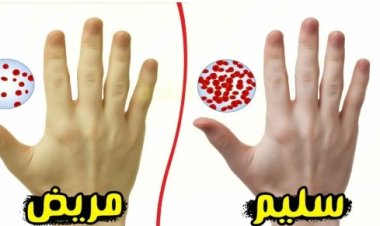 أسباب وأعراض نقص الحديد.. تعرف عليها