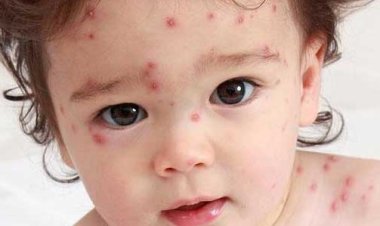 ما هو موض الجدري المائي المنتشر بين المدارس هذه الأيام ؟