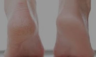  وصفات طبيعية لعلاج تشقق الكعب.. تعرفي عليها