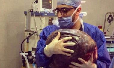 بطولة طبيب مصري.. جراحة استئصال لأحد أكبر الأورام في العالم لامرأة تُعاني من زيادة وزن مفاجئة