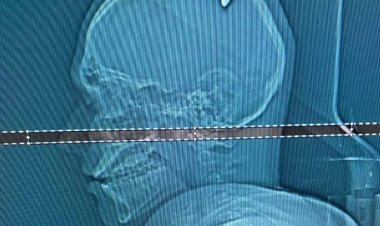 شاب برازيلي يعيش برصاصة في رأسه لمدة 4 أيام دون أن يدرك