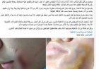 ضبط طالب اعتدى على زميله بقطعة زجاج وأصابه في وجهه بالبحيرة