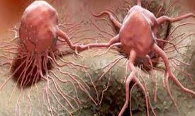 تقرير الوكالة الدولية لأبحاث السرطان.. ارتفاع ملحوظ في حالات الإصابة عالميًا وتحديات مستقبلية