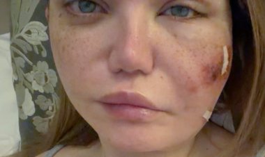 ياسمين الخطيب تعلن إصابتها بعدوى بكتيرية في أنسجة بشرة الوجه