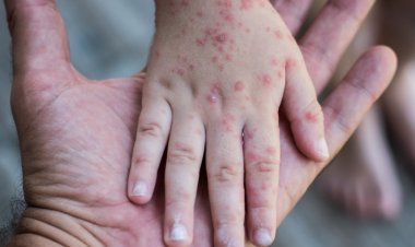 مسؤولو الصحة الأمريكيون: ارتفاع ملحوظ في حالات الإصابة بمرض الحصبة حول العالم