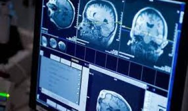 اكتشاف جديد.. اختبار دم مبتكر لتشخيص سرطانات الدماغ وتحسين فرص العلاج المبكر