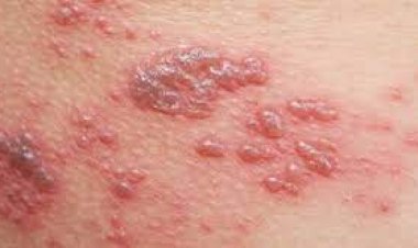 ما هو سبب ظهور الحزام الناري؟.. كيفية الوقاية من الحزام الناري