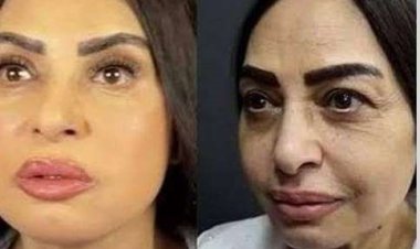 سلوى خطاب تكشف أسباب خضوعها لشد الوجه العميق: «كنت بخاف»