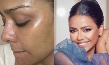 أسماء أبو اليزيد تكشف تطورات حالتها بعد تعرضها لحروق في وجهها