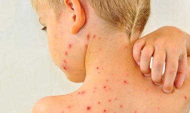 عدم تطعيم 1.8 مليون طفل.. طبيب يكشف سبب ارتفاع الإصابة بالحصبة