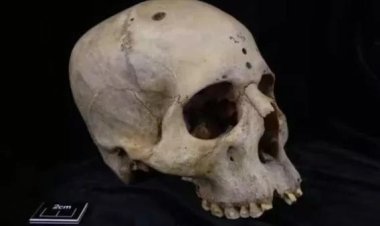 كيف عالج الفراعنة مرض السرطان؟.. جمجمة عمرها 4000 سنة تكشف السر