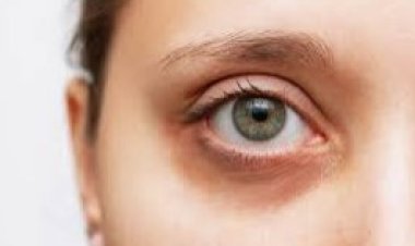 اعرفي أسباب ظهور الهالات السوداء وطرق علاجها
