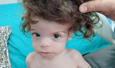 فريق طبي ينجح في فصل توأم ملتصق بالرأس والمخ في الإسكندرية.. تفاصيل