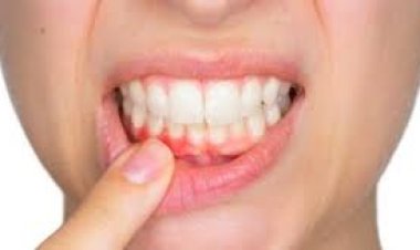 تسوس الأسنان في شهر رمضان.. كيفية التعامل والوقاية