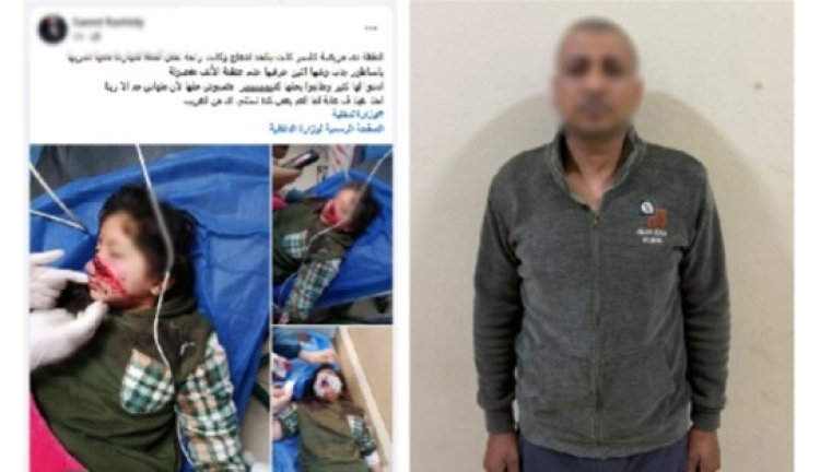 خلاف على محصول أرض زراعية يتنهى بتمزيق وجه صغيرة باستخدام ساطور 