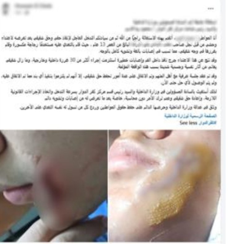 ضبط طالب اعتدى على زميله بقطعة زجاج وأصابه في وجهه بالبحيرة